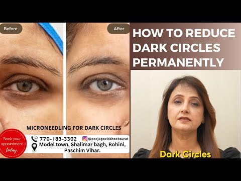 How to Reduce Dark Circles Permanently | Micro needling for Dark Circles Dark circles Treatment