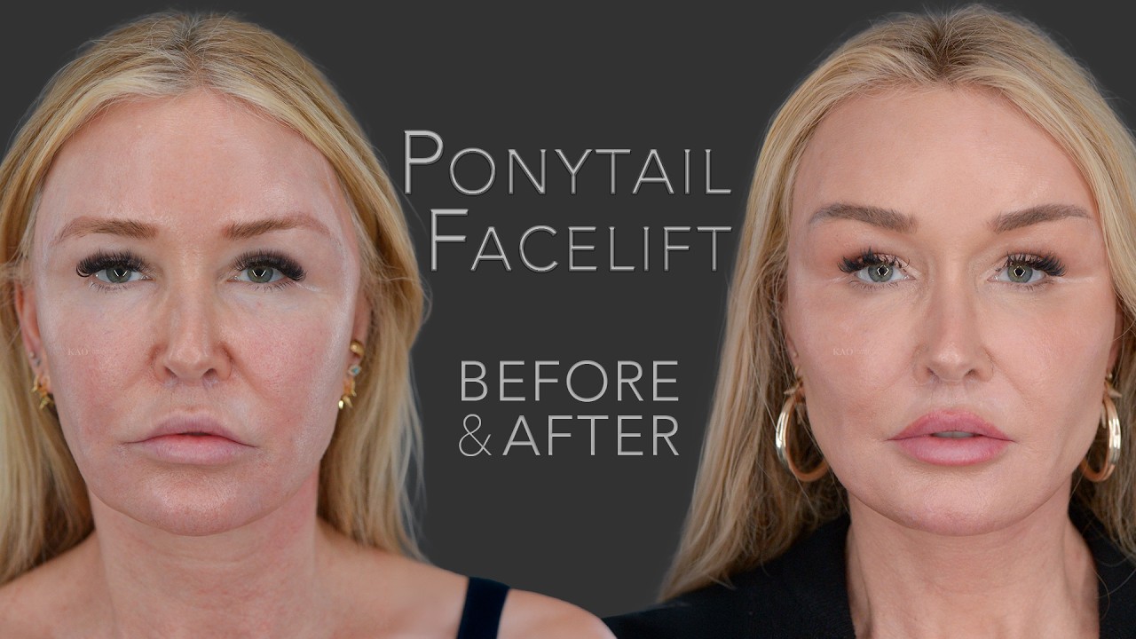 Revision Ponytail Facelift patient whose facial harmony was restored after years of previous cosmetic procedures