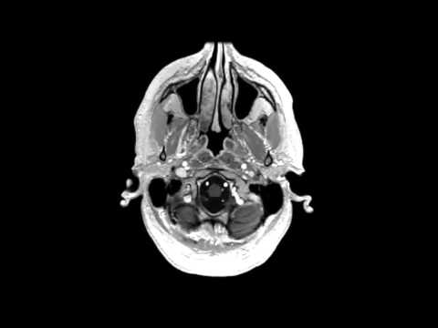 High-resolution whole-brain DCE-MRI using constrained reconstruction: Prospective clinical