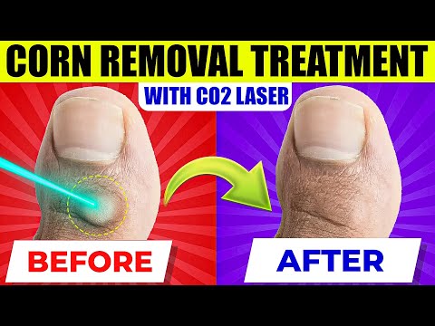 Corn Removal Treatment with Fractional CO2 Laser