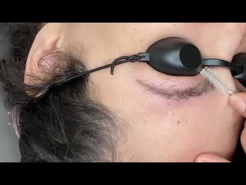 Remoção de Sobrancelhas Tatuadas e Escuras a Laser em Goiatuba