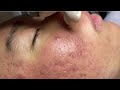 Acne treatment for Spa Linh Mun 2024 #107