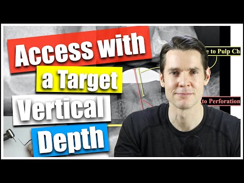 Endodontic Access Using Target Vertical Depth Measurements