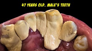 [問卦] 日本人的牙齒怎麼能那麼亂