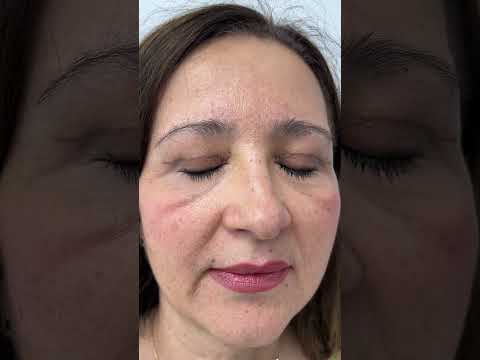 Transformare 🔥 SPECTACULOASĂ la 3 Luni de zile după operația de Blefaroplastie superioară [pleoape]