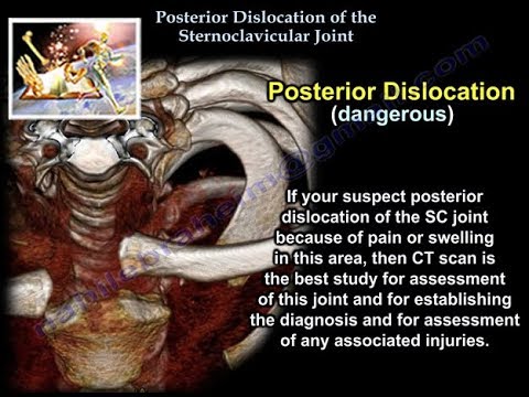 Patologia și tratamentul articulației sternoclaviculare