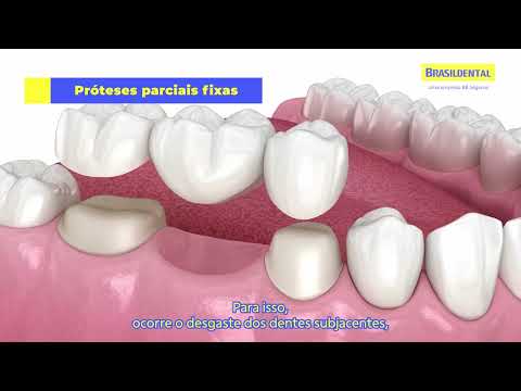 Tipos de Próteses Dentárias - Brasildental