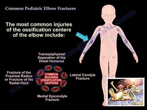 Common Pediatric Elbow Fractures - Everything You Need To Know - Dr. Nabil Ebraheim