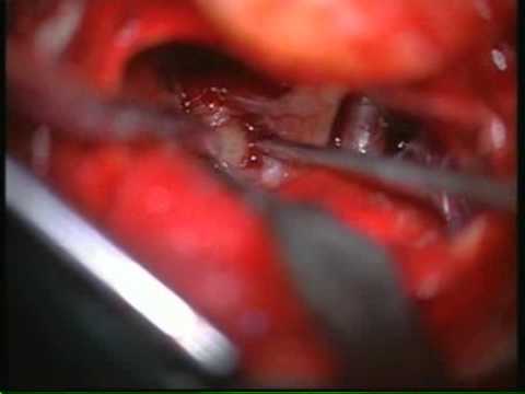 Endoscopically assisted mini orbitozygomatic keyhole approach 