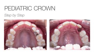 edelweiss PEDIATRIC CROWN Step By Step