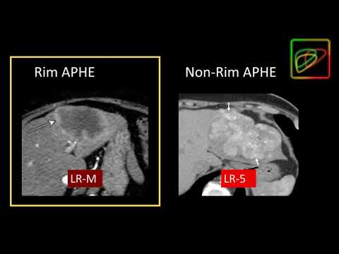 5. LI-RADS: Malignant lesions that are not definitely HCC: LR-M - Part 1. By Dr. Kathryn Fowler.