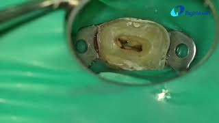 POV clinical presentation of RCT of tooth 14 from start to finish unedited. 