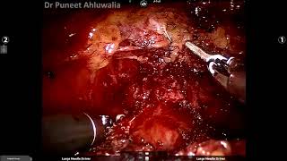Dr Puneet Ahluwalia RARP Vesicourethral anastomosis