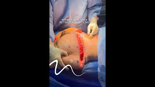 Cirugía de retiro de biopolímeros | ¿Cómo creen que quedará la paciente