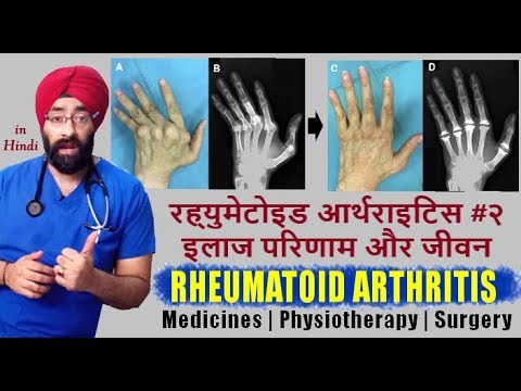 How to Live with Rheumatoid Arthritis #2 (HINDI) गठिया आर्थराइटिस निदान और जीवन | Dr.Education Video