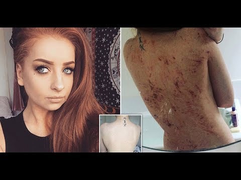 Psoriasi a bambini podoshvenno palmar Statistica dincidenza di dermatite atopic