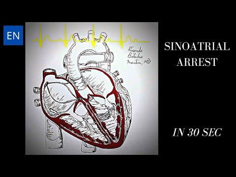 Sinus Arrest - Animation and ECG