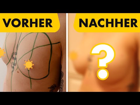 Kleine Brust auf mittelgroße Brust vergrößert! Dr. Jungwirth