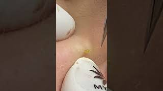 Hard Blackhead Removal – It Was Much Bigger Than Expected! 😅