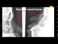CASE 717 Fracture nasal bone