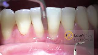 Raspagem Supragengival e subgengival com Ultrassom ( Sem Aerossol)