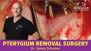 Pterygium Removal *WATCH SURGERY*