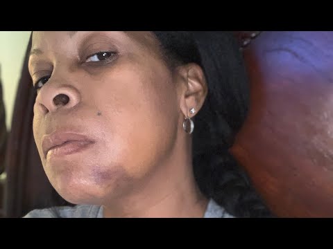 Day7! Extractions/implants/temporary dentures.