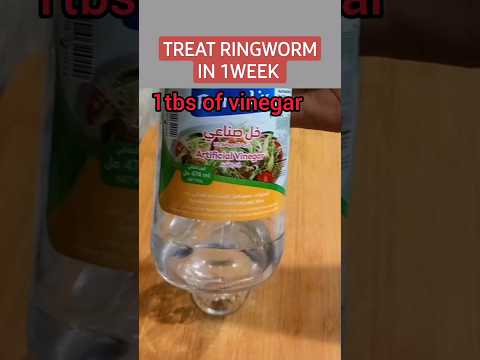 How to treat ringworm in 1week! #youtubeshorts#diy #viral #shortsfeed #trendingshorts #ringworm