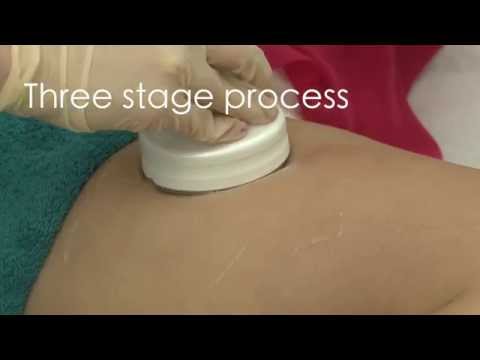 Promax Lipo at Changes Clinic Short Version
