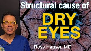 Can dry eyes be caused by neck instability? Potential ligamentous etiology of dry eye disease