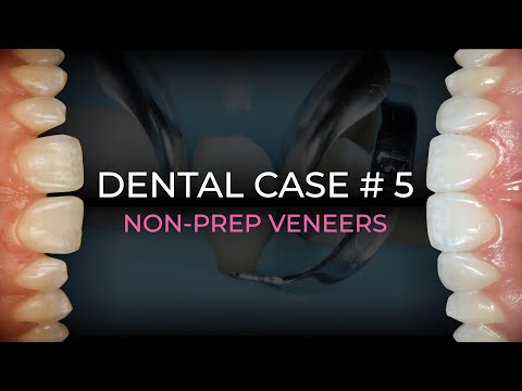 Non-prep veneers| Dental case #5