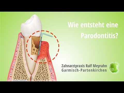Zahnarzt Garmisch Parodontitis-Entstehung - Ralf Meyrahn
