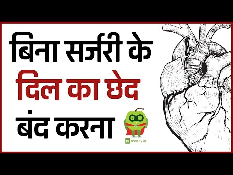 बिना सर्जरी के दिल का छेद बंद करना | "Hole" in heart can be cured without surgery | #healthyho