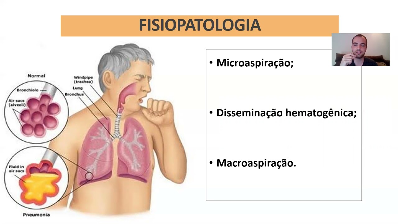 Manejo da pneumonia adquirida na comunidade.