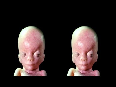 In the Womb: Identical Twins