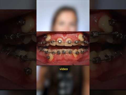 Si tienes los dientes muy APIÑADOS, este time lapse de brackets te va a INTERESAR
