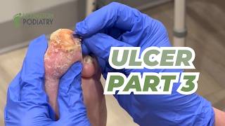 Urgent Ulcer Update | Part 3