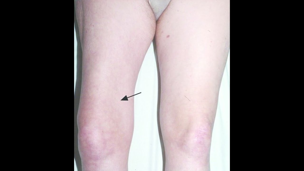 【糖尿病性筋萎縮症】急な痛みで始まって、太ももが段々と細くなってきたら。。