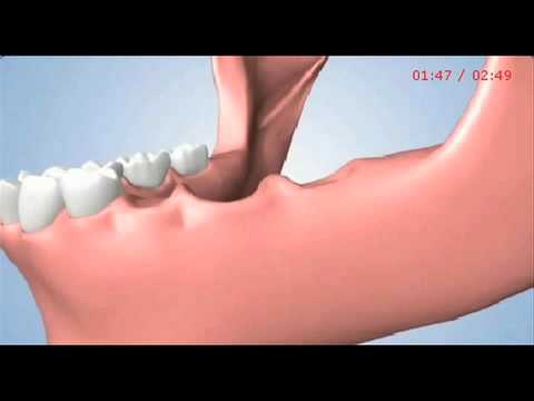 Treatment Options for Several Missing Teeth