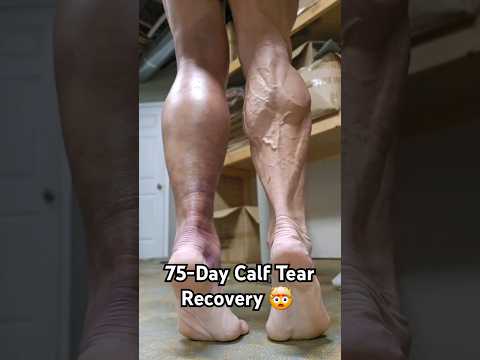 75 Day Calf Tear Recovery