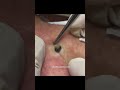 Dr Pimple Popper's Most Popular Pop #shorts