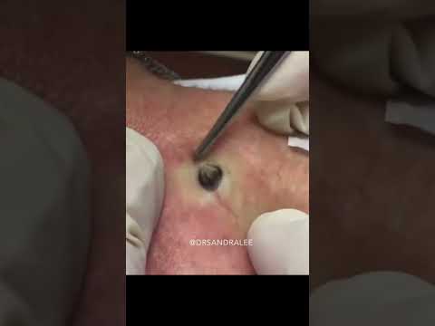 Dr Pimple Popper's Most Popular Pop #shorts