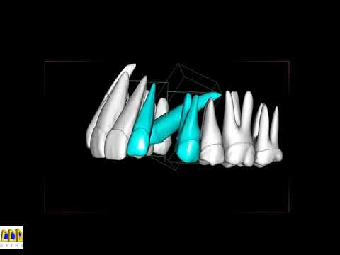 Impacted canine movement in orthodontics