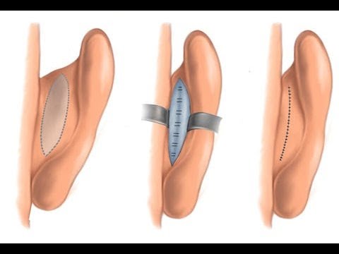 Otoplastika — Dr. Choriyev #2