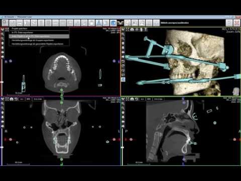 Komplex für Knochen und Gelenke Megavit Osteo suoja 20 pc Ob es möglich ist, Meloxicam in Osteochondrose stechen