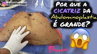 ABDOMINOPLASTIA Por que a Cicatriz é Grande  Dr Valter Hugo