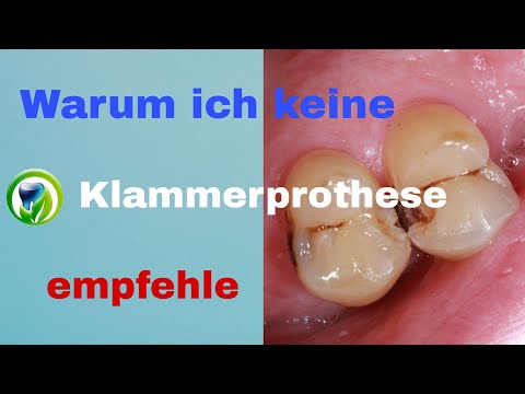 Warum ich keine Klammerprothese / Modellgussprothese empfehle - Mogu, Karies, lockerer Zahnersatz
