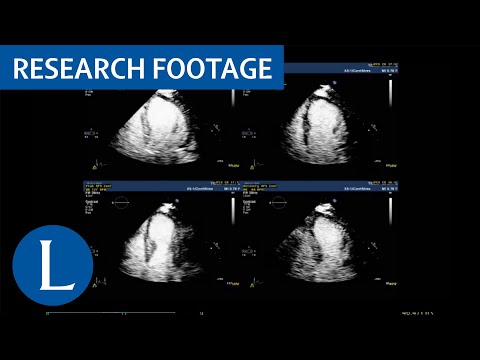 Dobutamine stress echocardiography to diagnose coronary artery disease