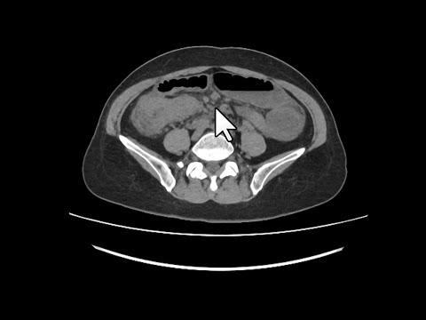 Tumor de Krukenberg. Achados típicos da tomografia computadorizada.