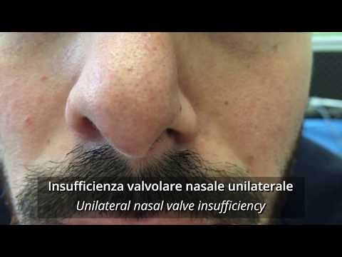 Insufficienza della valvola nasale: dilatatore nasale vs cerotto nasale